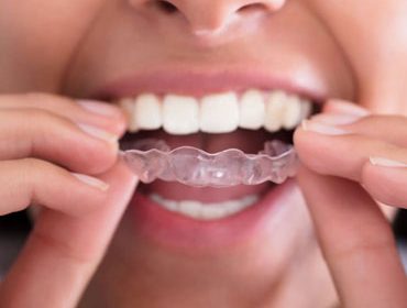most affordable clear aligners
