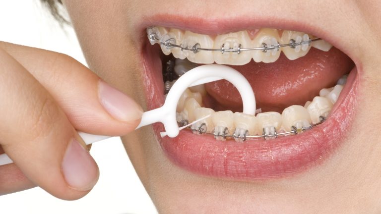 Brace Life: Tips for Eating, Brushing, and Maintaining Oral Hygiene