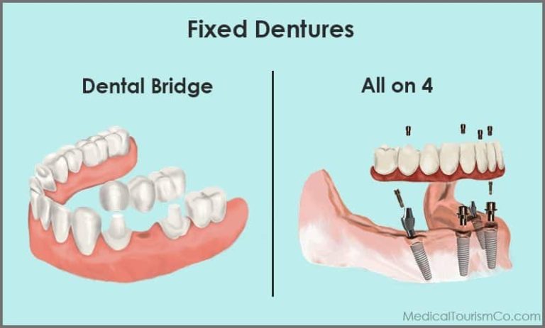 Cost Analysis: Dental Implants vs. Bridges vs. Dentures