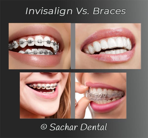 Invisalign vs. Braces: Which is Faster, Better, and More Affordable?