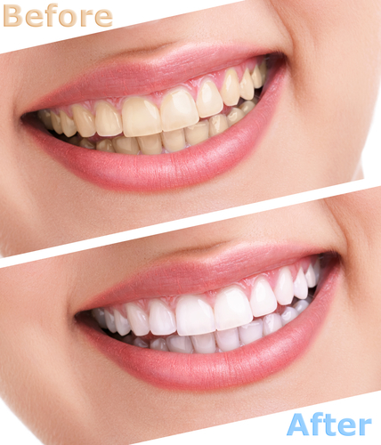 The Real Cost of Veneers: Are They Worth It for a Perfect Smile?