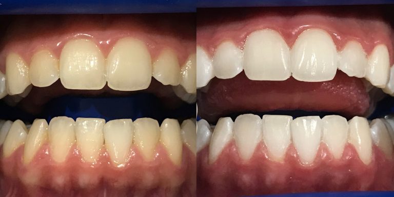 Teeth Whitening Techniques: What Works and What Doesn’t?