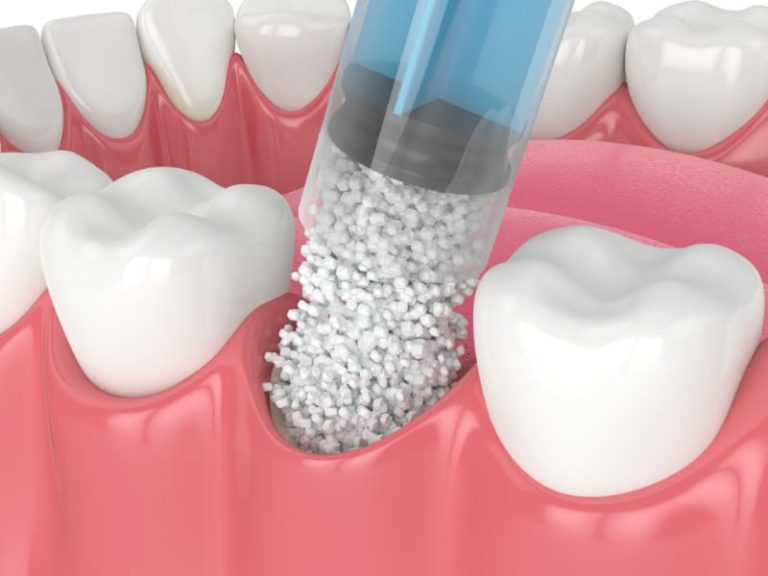 Dental Implants: The Solution for Missing Teeth and Potential Bone Loss