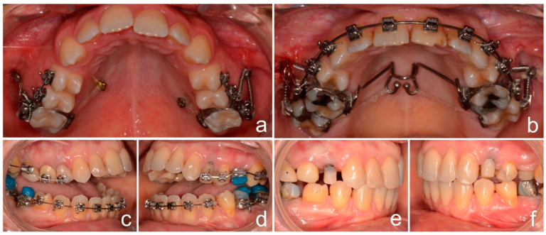 Do Orthodontic Solutions Help with TMJ Issues? What You Need to Know
