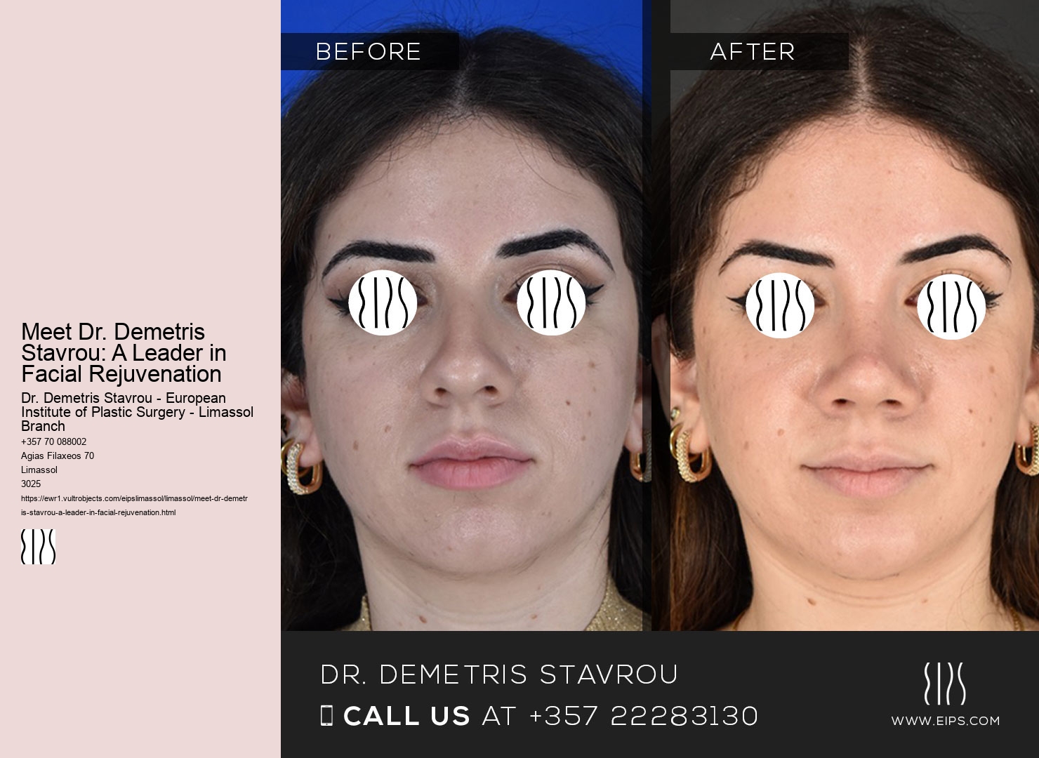 Meet Dr. Demetris Stavrou: A Leader in Facial Rejuvenation