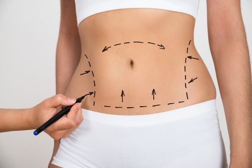 liposuction on stomach