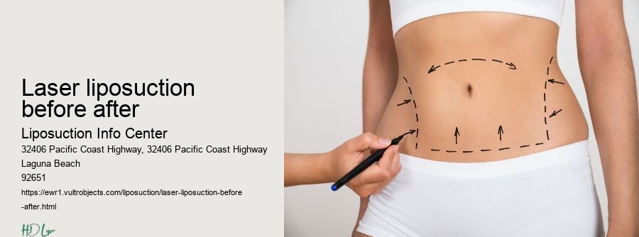laser liposuction before after