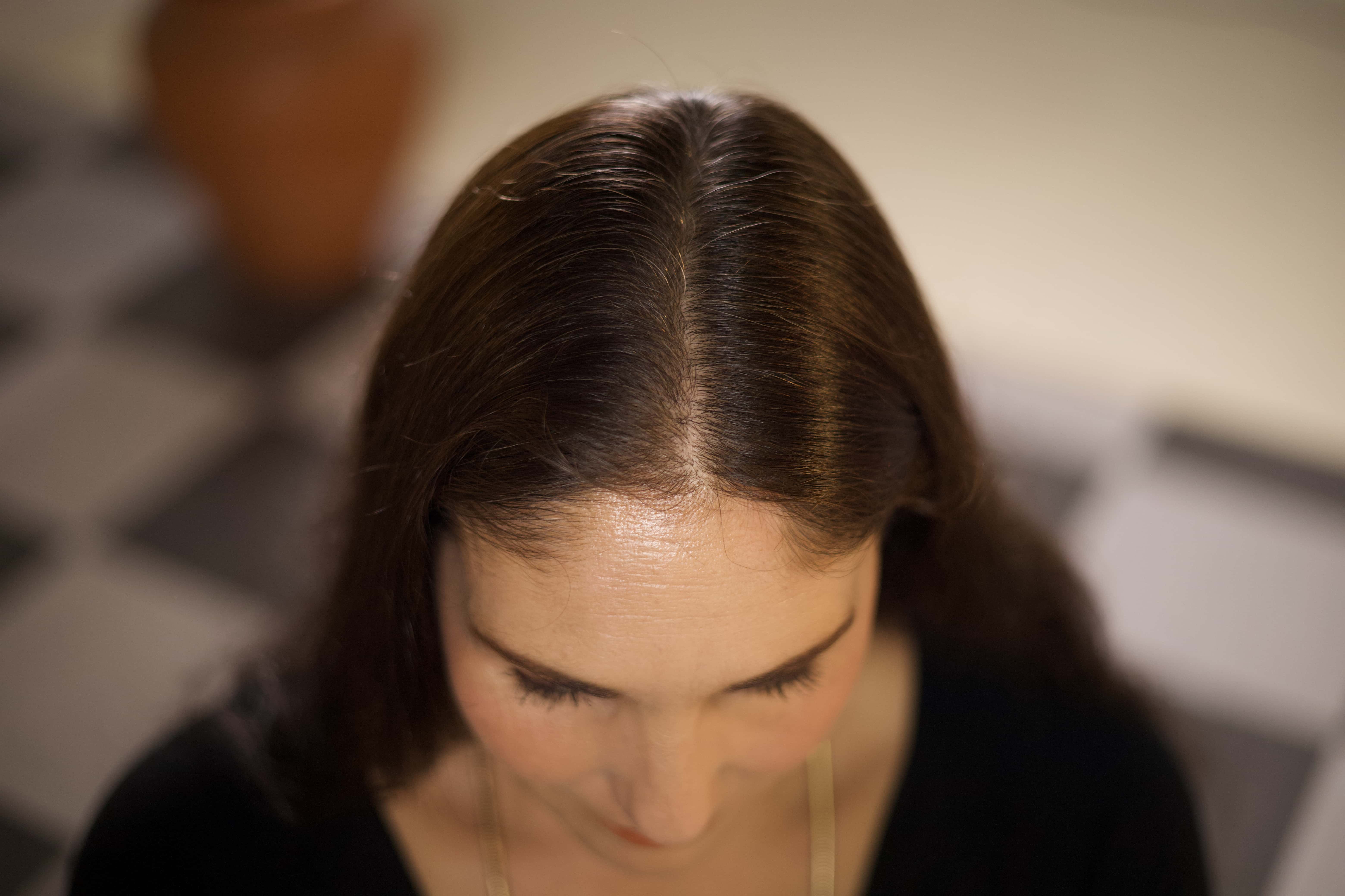 What Causes Hair Loss - Magic Hair