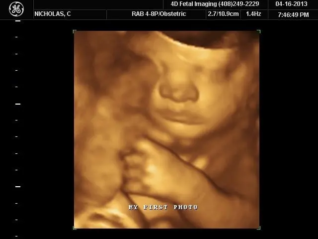 4D Fetal Imaging