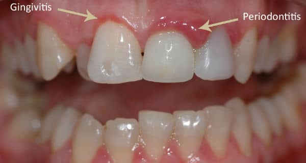 Natural Remedies for Gum Disease: Fact or Fiction?
