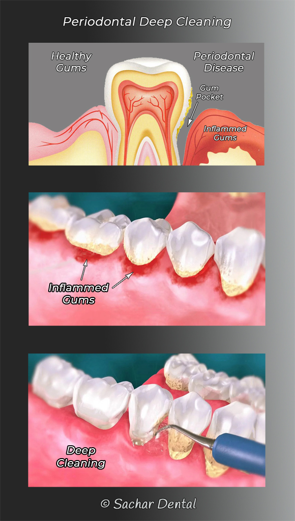 Scaling and Root Planing: What to Expect for Gum Disease Treatment