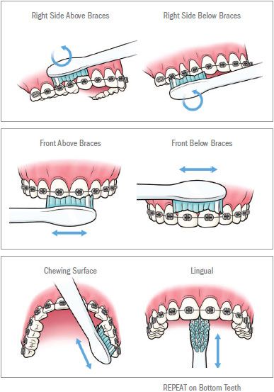 How to Care for Your Teeth While Wearing Braces