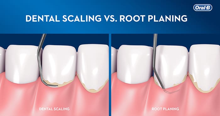 The Dental Scaling Process: Step-by-Step Explanation