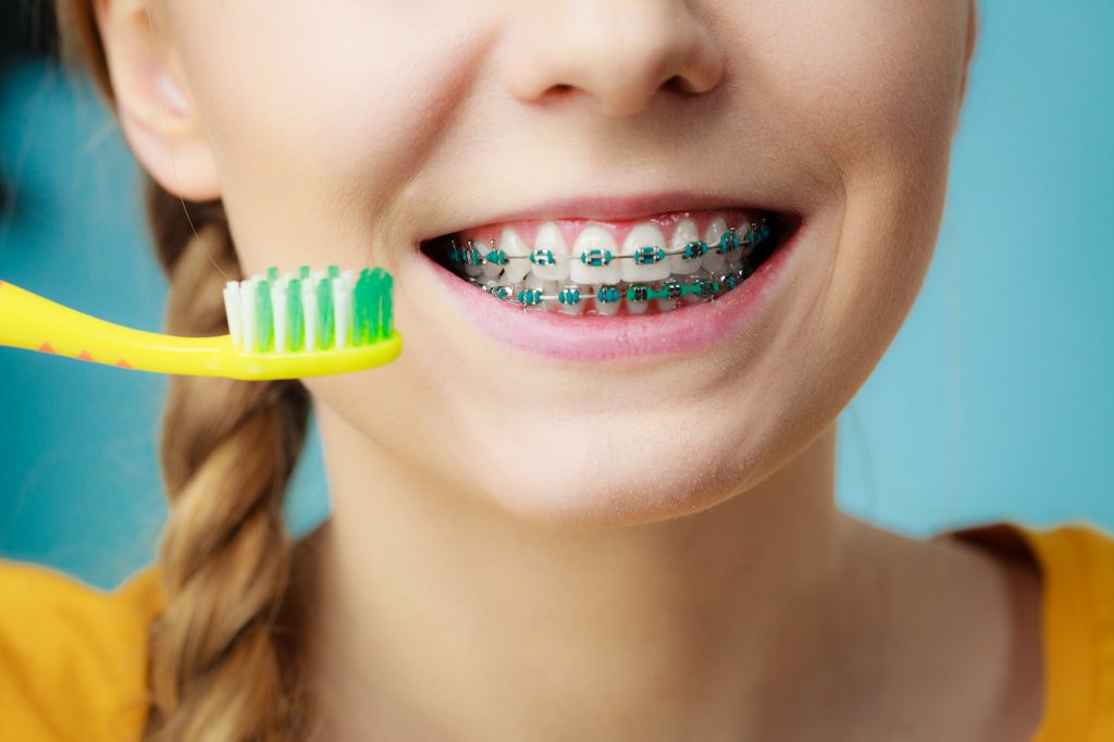 Life with Braces: Tips for Eating and Oral Hygiene