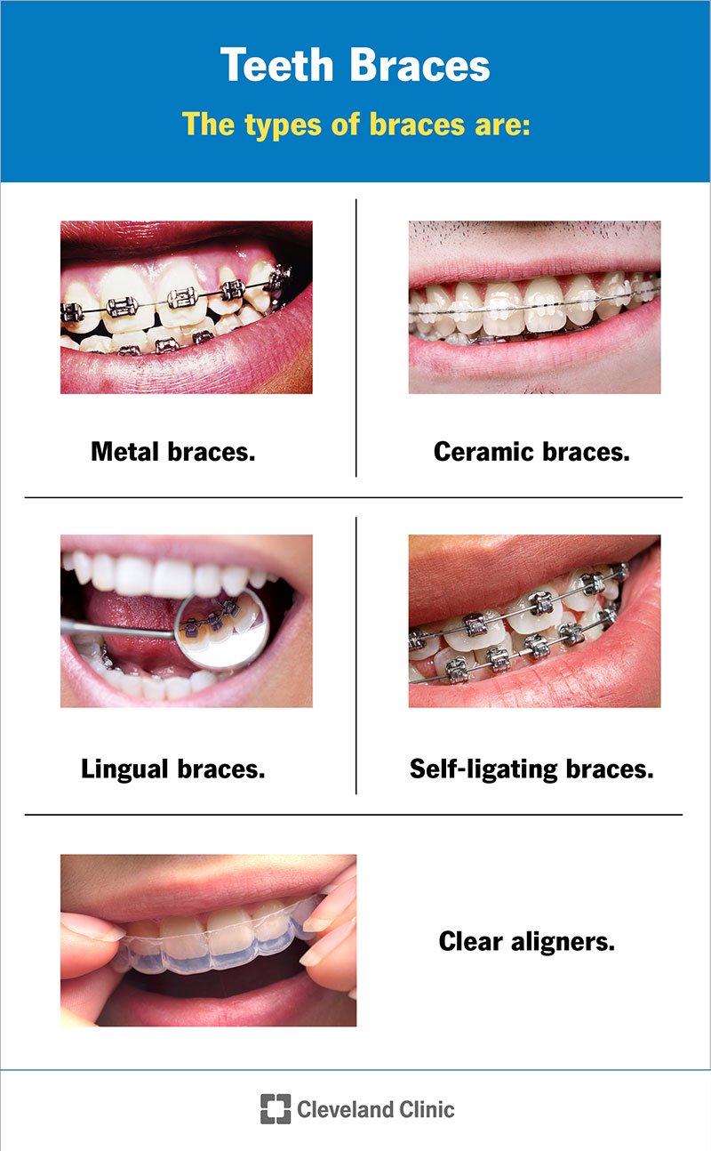 Time Under Tension: How Long Do You Really Need to Wear Braces?
