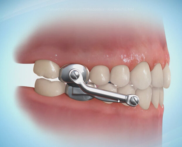 Braces Troubleshooting: How to Handle Common Issues with Orthodontic Appliances