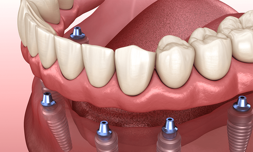 The Price of a New Smile: Breaking Down the Costs of Dental Implants
