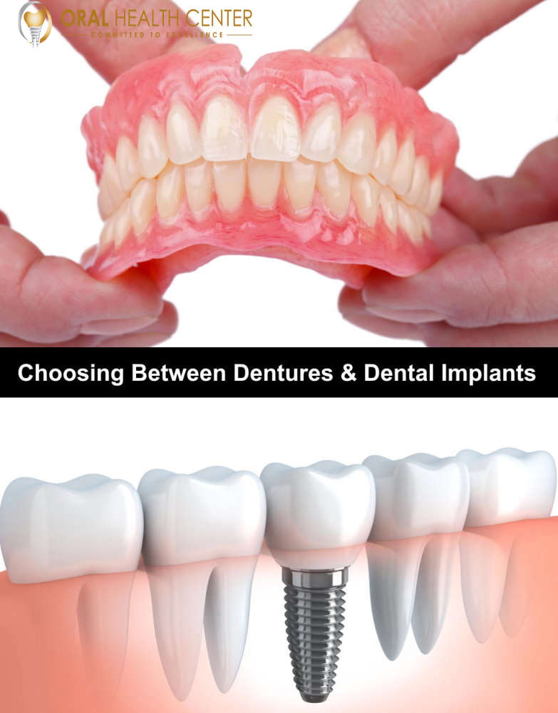 Dental Implants vs. Dentures: Making an Informed Decision for Your Oral Health