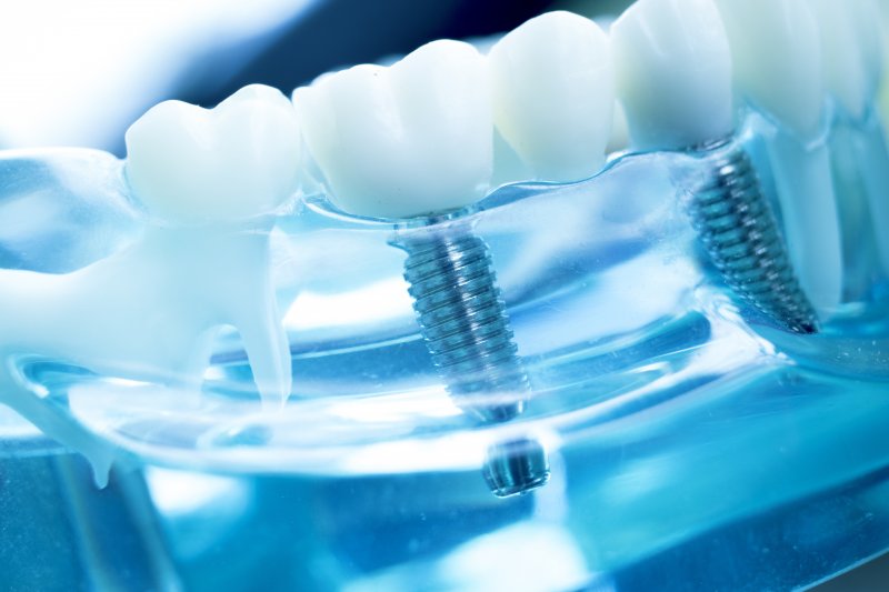Dental Implants and the Latest Advancements in Tooth Replacement Technology
