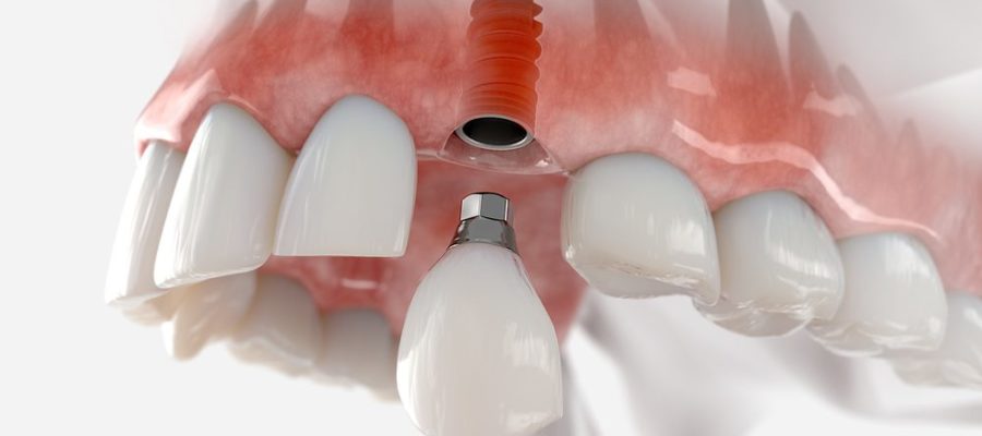 3D Printing in Dentistry: Revolutionizing Prosthetics and Restorations